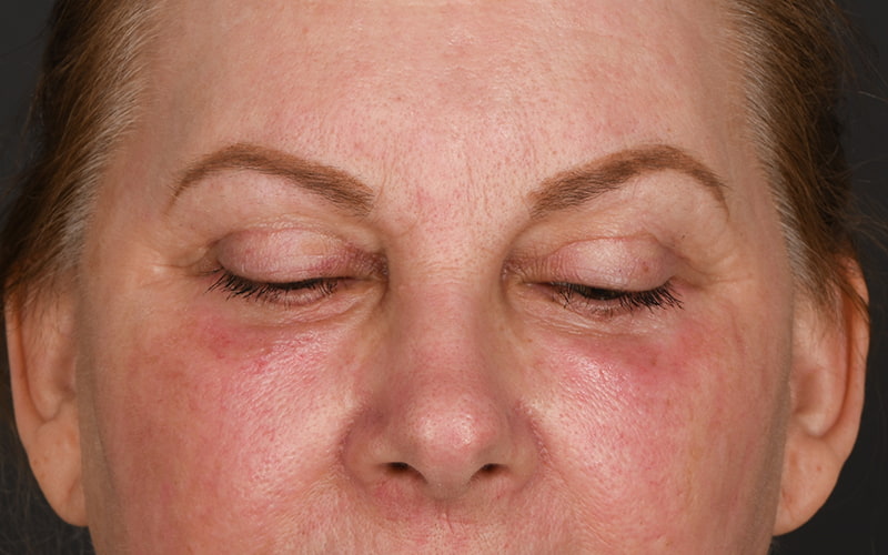 Upper Blepharoplasty Before & After Image