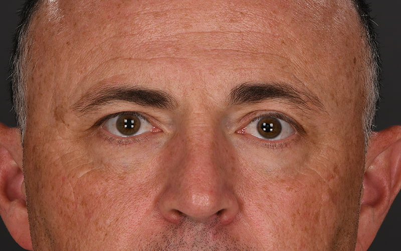 Upper Blepharoplasty Before & After Image