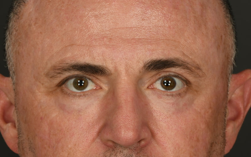 Upper Blepharoplasty Before & After Image