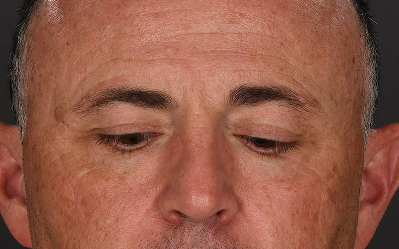 Upper Blepharoplasty Before & After Image