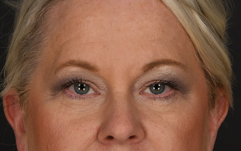 Upper Blepharoplasty Before & After Image
