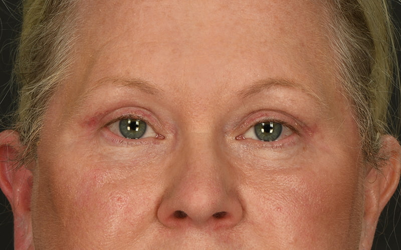 Upper Blepharoplasty Before & After Image
