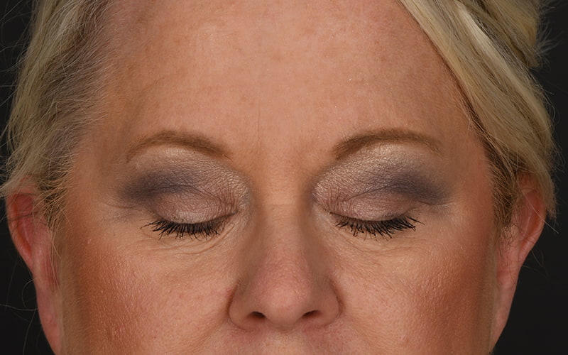 Upper Blepharoplasty Before & After Image