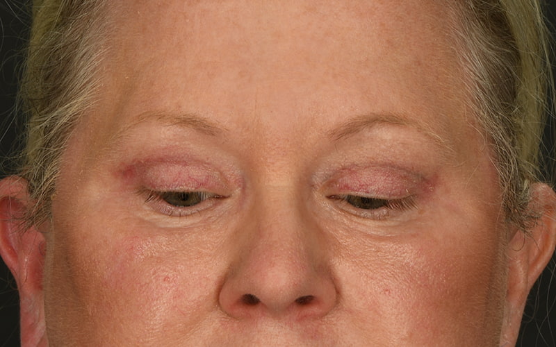 Upper Blepharoplasty Before & After Image
