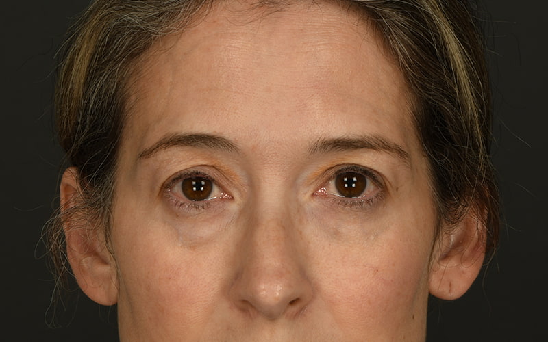 Upper Blepharoplasty Before & After Image