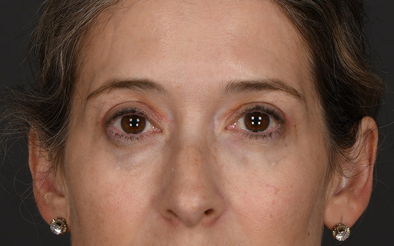 Upper Blepharoplasty Before & After Image