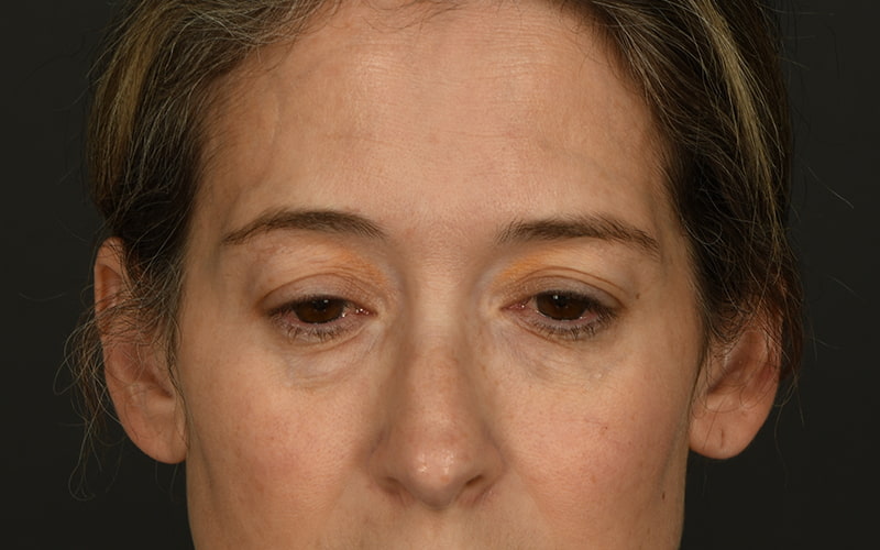Upper Blepharoplasty Before & After Image