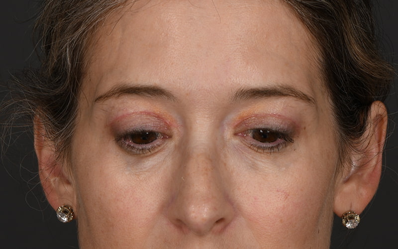 Upper Blepharoplasty Before & After Image