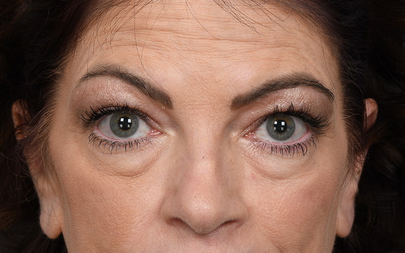 Upper Blepharoplasty Before & After Image