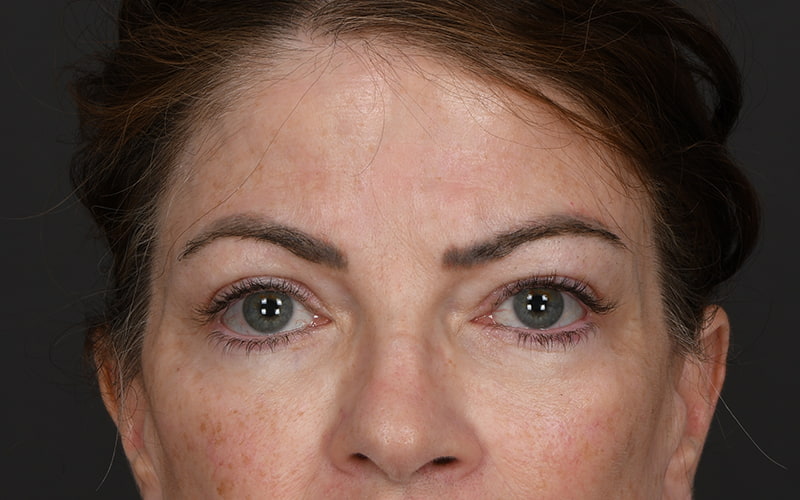 Upper Blepharoplasty Before & After Image
