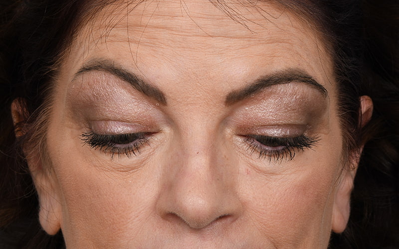 Upper Blepharoplasty Before & After Image