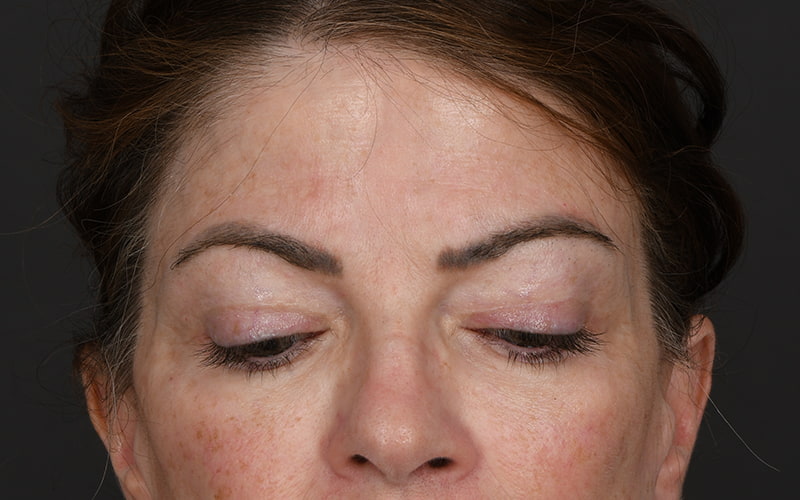Upper Blepharoplasty Before & After Image