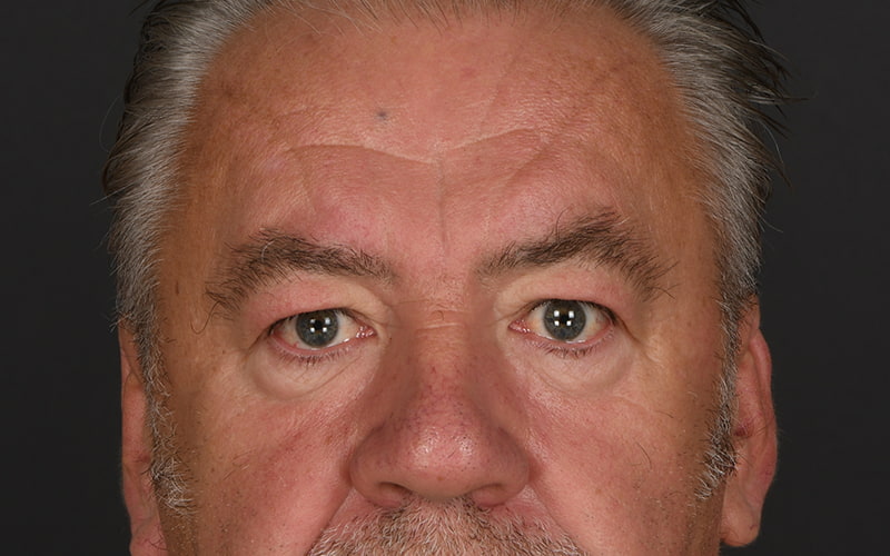Upper Blepharoplasty Before & After Image
