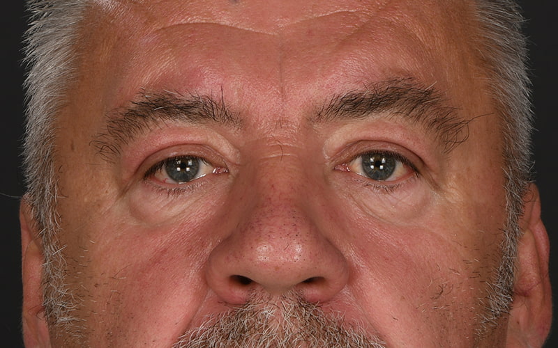 Upper Blepharoplasty Before & After Image