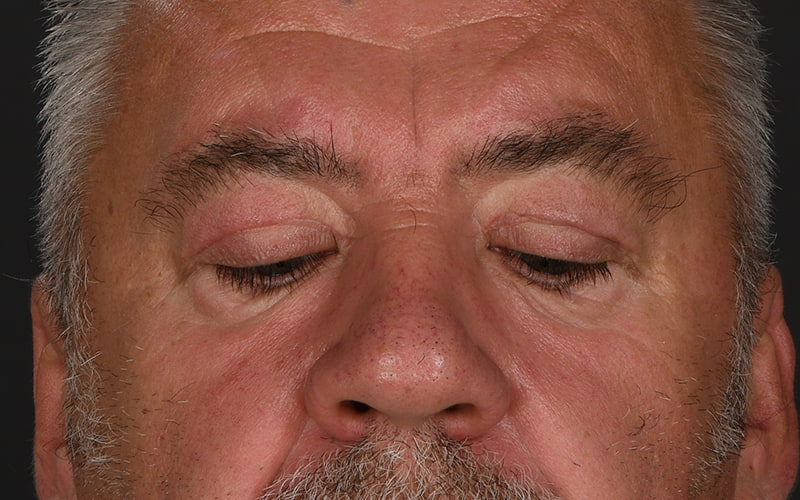 Upper Blepharoplasty Before & After Image