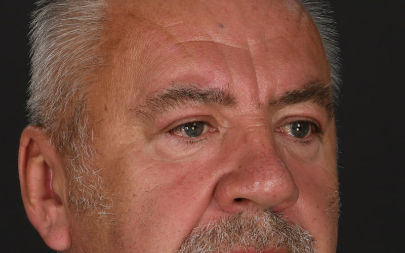 Upper Blepharoplasty Before & After Image