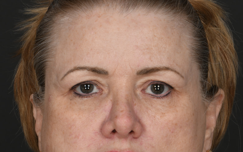 Upper blepharoplasty Before & After Image