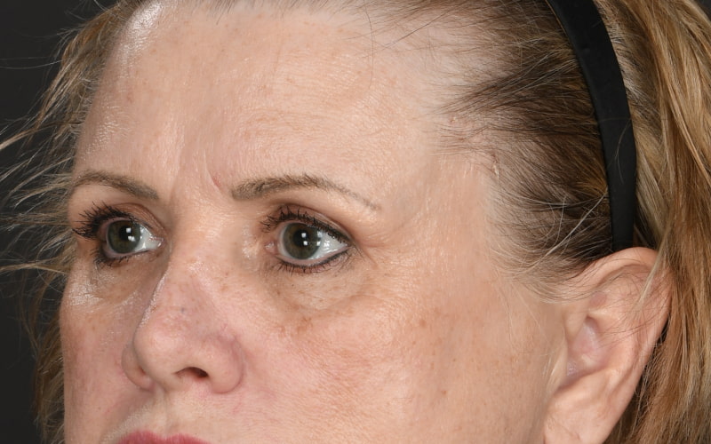 Upper blepharoplasty Before & After Image
