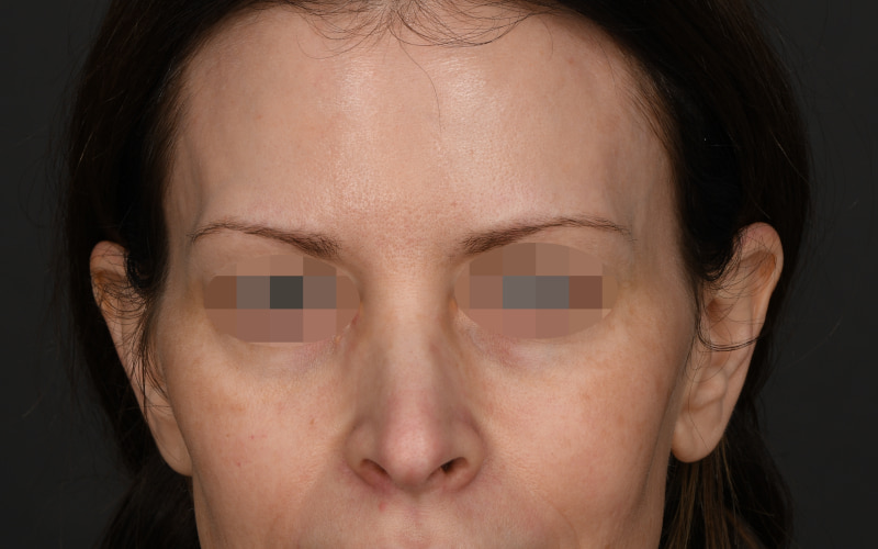 Upper blepharoplasty Before & After Image