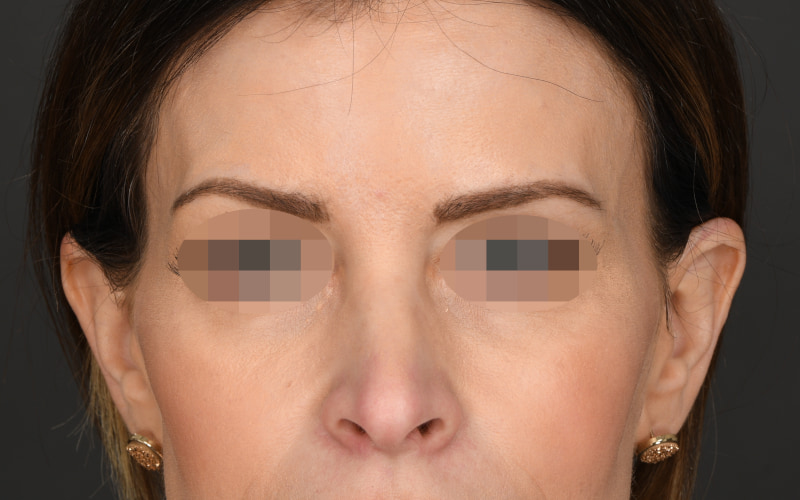 Upper blepharoplasty Before & After Image
