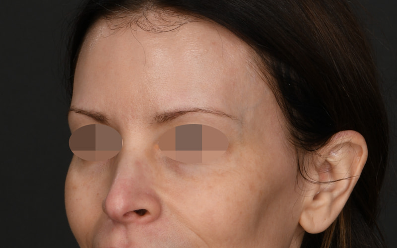 Upper blepharoplasty Before & After Image