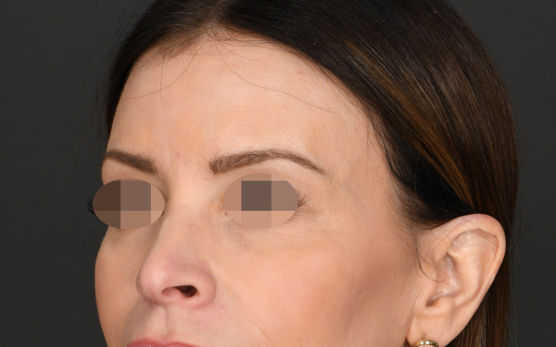 Upper blepharoplasty Before & After Image