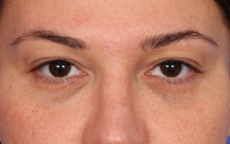 Upper blepharoplasty Before & After Image