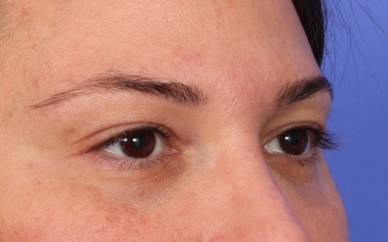 Upper blepharoplasty Before & After Image