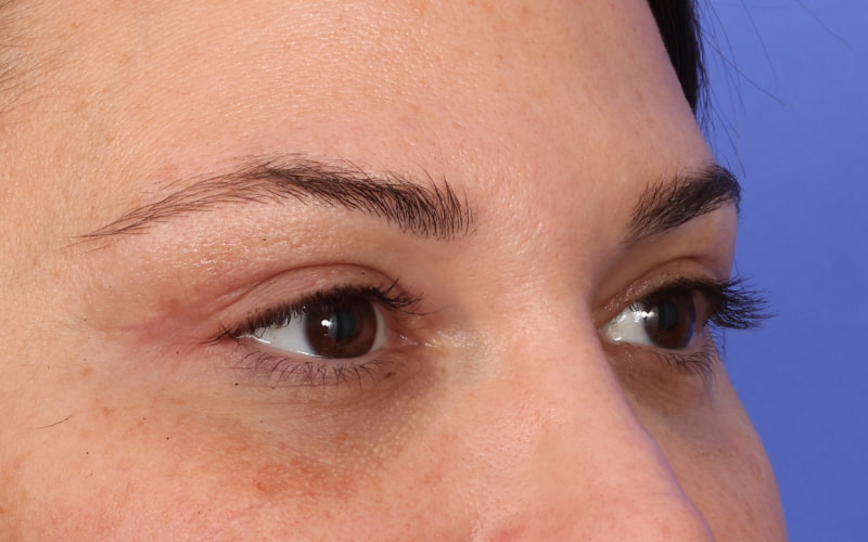 Upper blepharoplasty Before & After Image