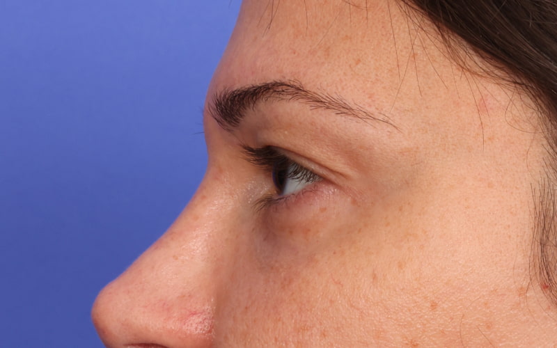 Upper Blepharoplasty Before & After Image