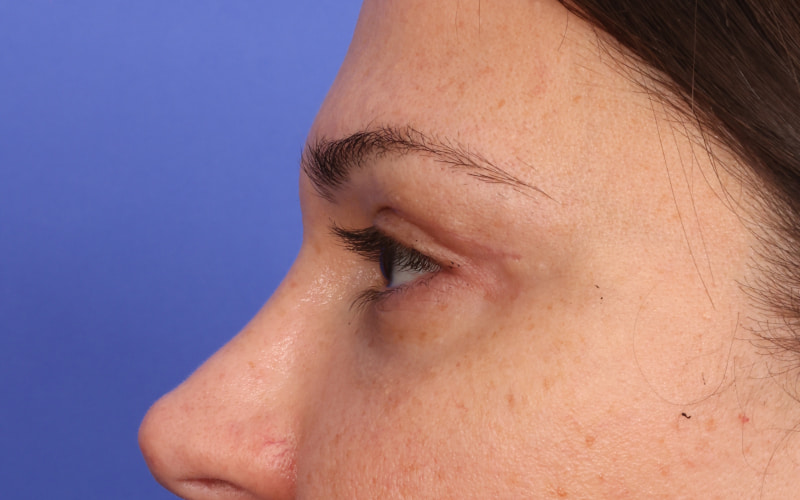 Upper Blepharoplasty Before & After Image