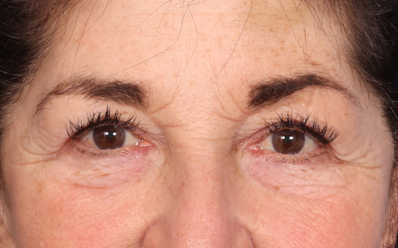 Upper blepharoplasty Before & After Image
