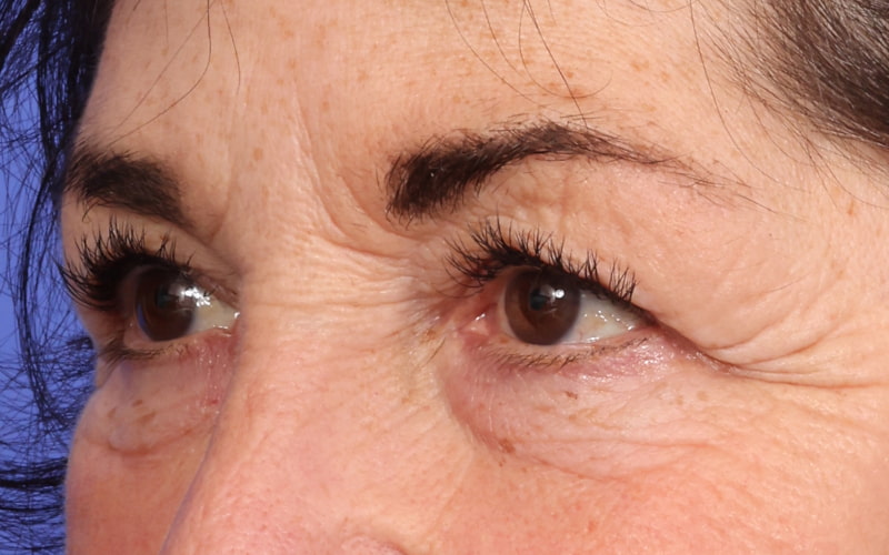 Upper blepharoplasty Before & After Image
