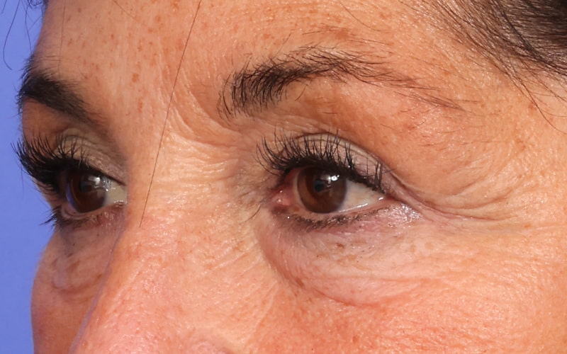 Upper blepharoplasty Before & After Image