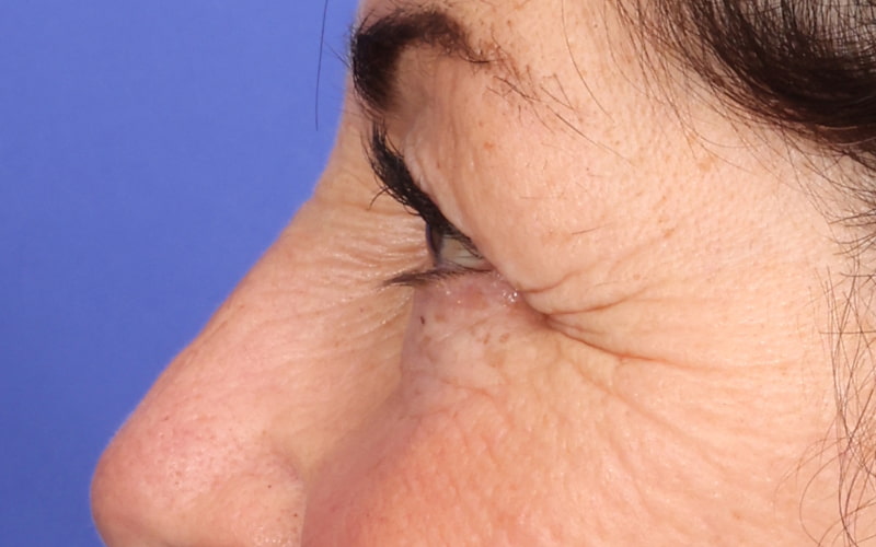 Upper Blepharoplasty Before & After Image