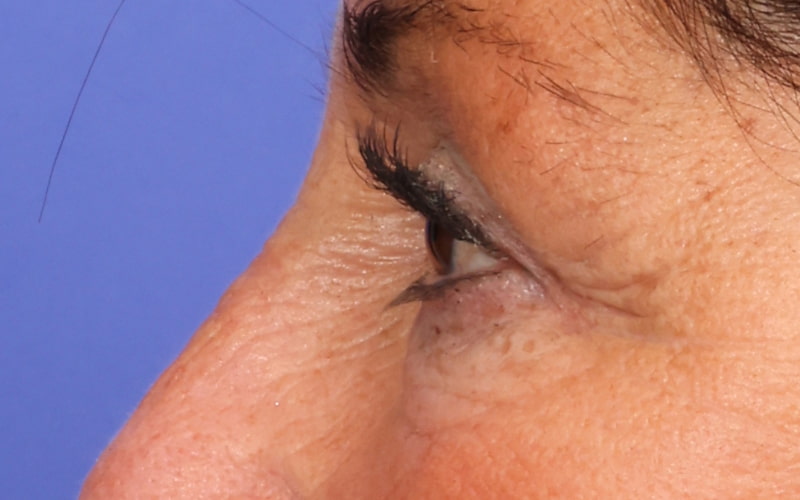 Upper Blepharoplasty Before & After Image