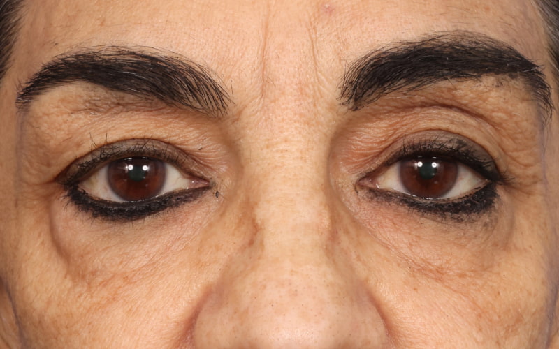 Upper blepharoplasty Before & After Image