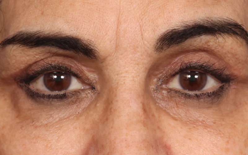 Upper blepharoplasty Before & After Image