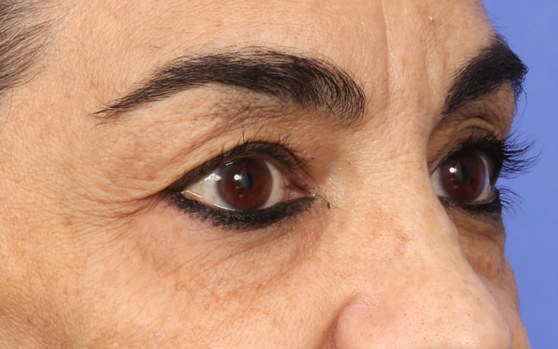 Upper blepharoplasty Before & After Image