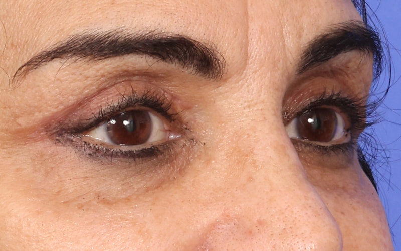 Upper blepharoplasty Before & After Image