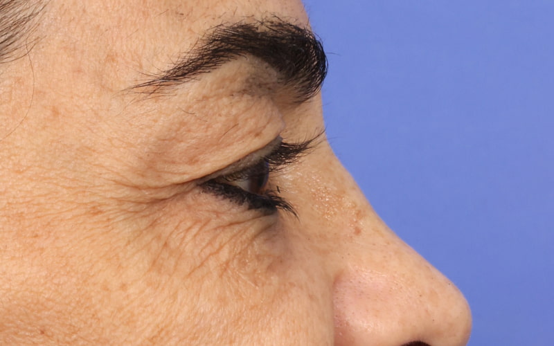 Upper Blepharoplasty Before & After Image