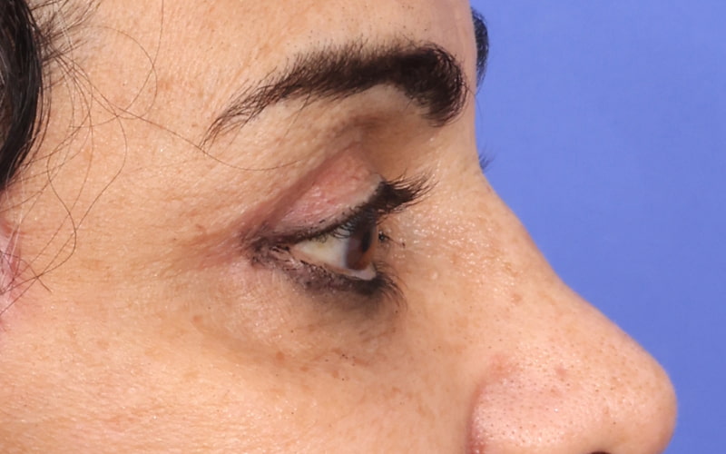 Upper Blepharoplasty Before & After Image