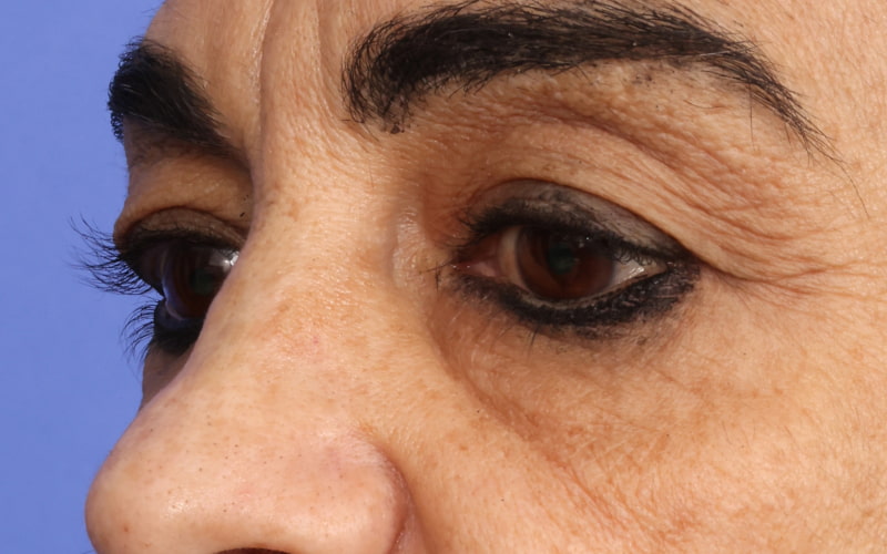 Upper Blepharoplasty Before & After Image