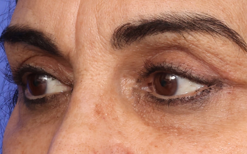 Upper Blepharoplasty Before & After Image