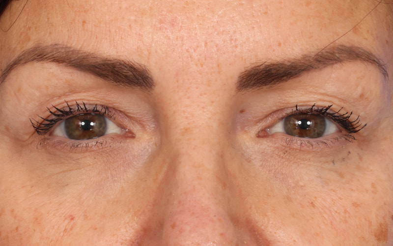Upper blepharoplasty Before & After Image