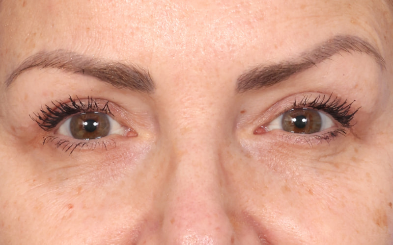 Upper blepharoplasty Before & After Image