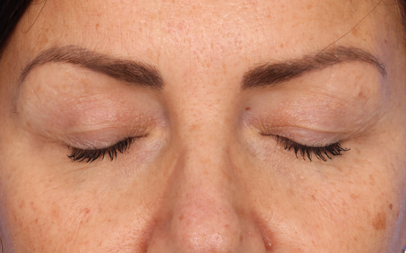 Upper blepharoplasty Before & After Image