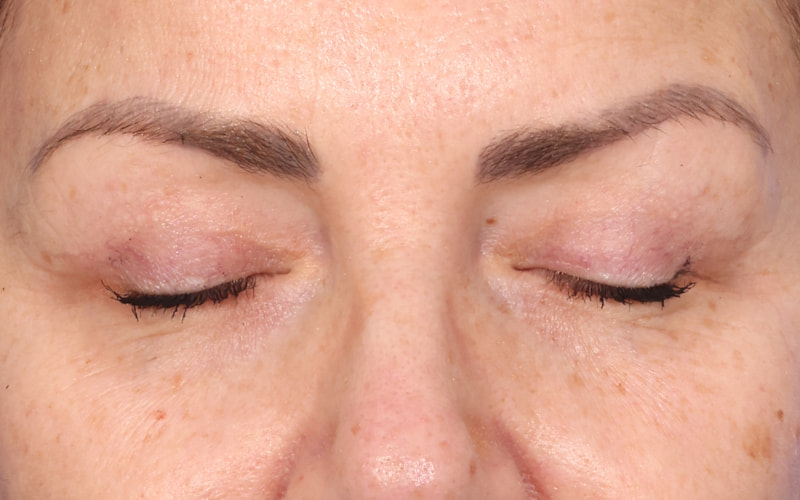 Upper blepharoplasty Before & After Image