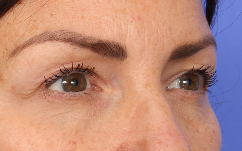 Upper Blepharoplasty Before & After Image