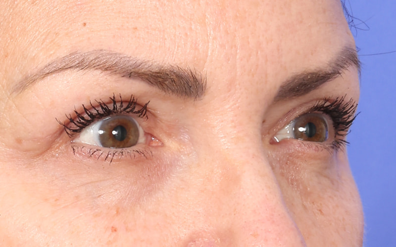 Upper Blepharoplasty Before & After Image